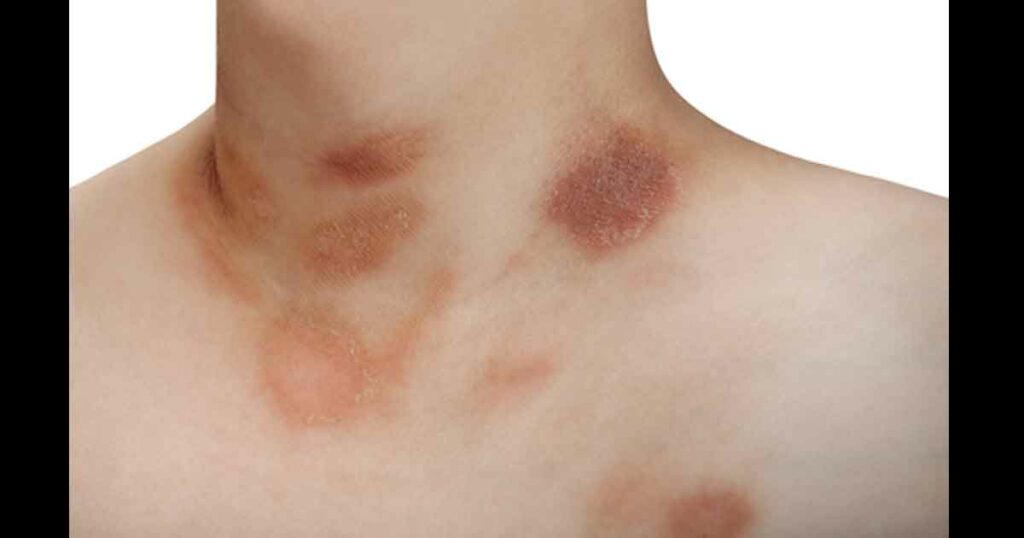 One person with Pityriasis rosea disease on the chest and neck on an isolated background