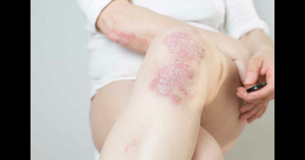 cute psoriasis on the knees ,body ,elbows is an autoimmune incurable dermatological skin disease. Large red, inflamed, flaky rash on the knees. Joints affected by psoriatic arthritis.