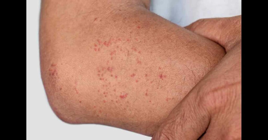 Multiple itchy mosquito or insect bite wheals; red spots on the forearm of Southeast Asian, Chinese adult man.