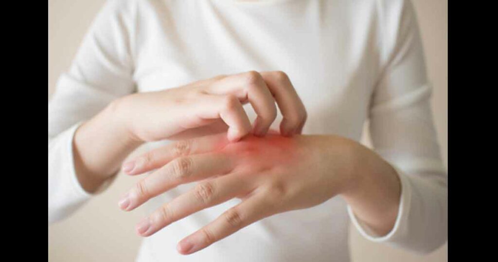 Young woman scratching the itch on her hands w/ redness rash. Cause of itchy skin include dermatitis (eczema), dry skin, burned, food/drugs allergies, insect bites. Health care concept. Close up.