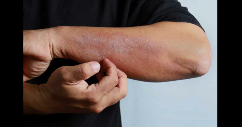 Close up dermatitis on man hand, allergic rash dermatitis eczema skin of a patient. Atopic dermatitis symptom skin detail texture, Fungus of skin. The concept of dermatology.