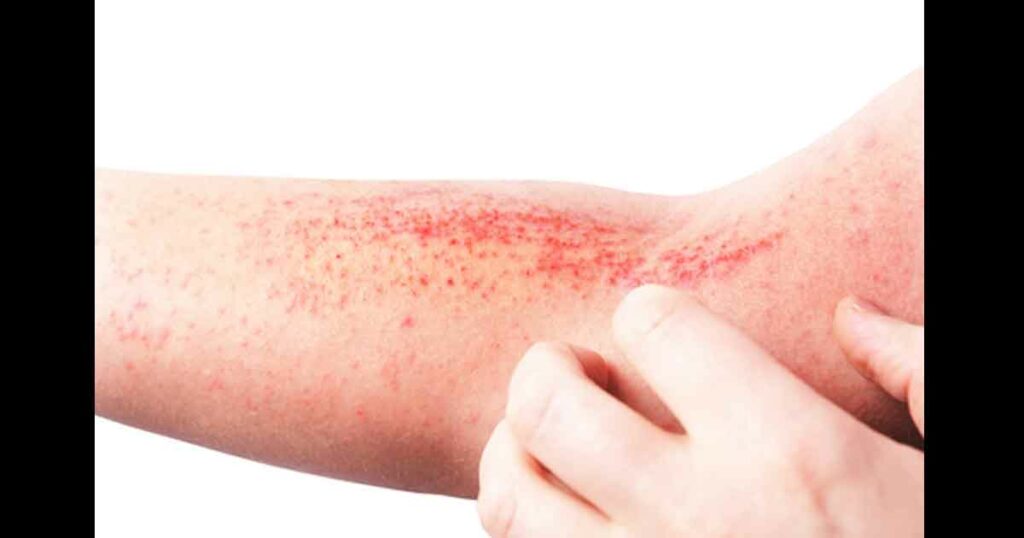 Atopic dermatitis (AD), also known as atopic eczema, is a type of inflammation of the skin (dermatitis) at foot