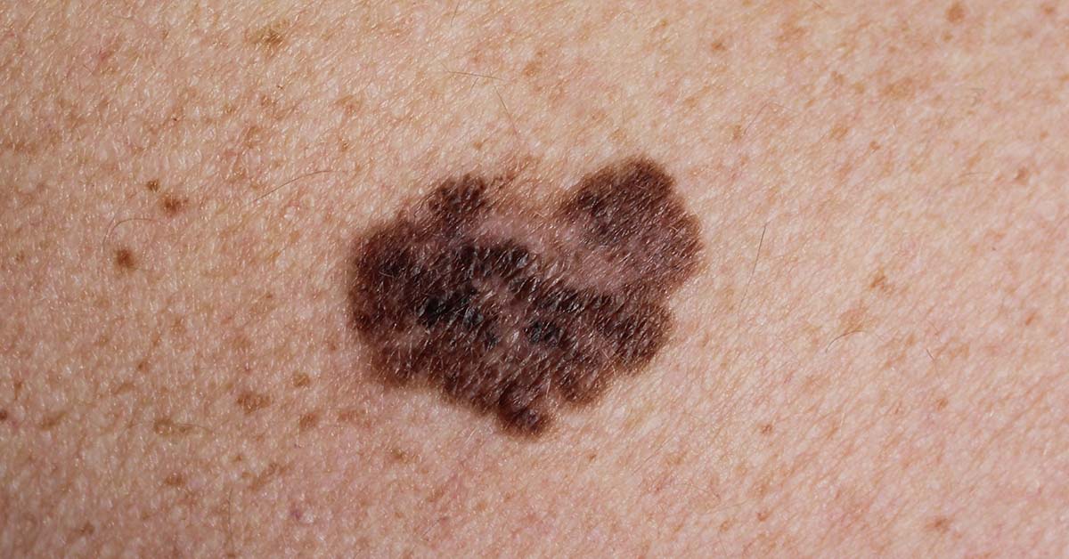Know Your ABCDEs: 5 Signs of Melanoma to Look Out For