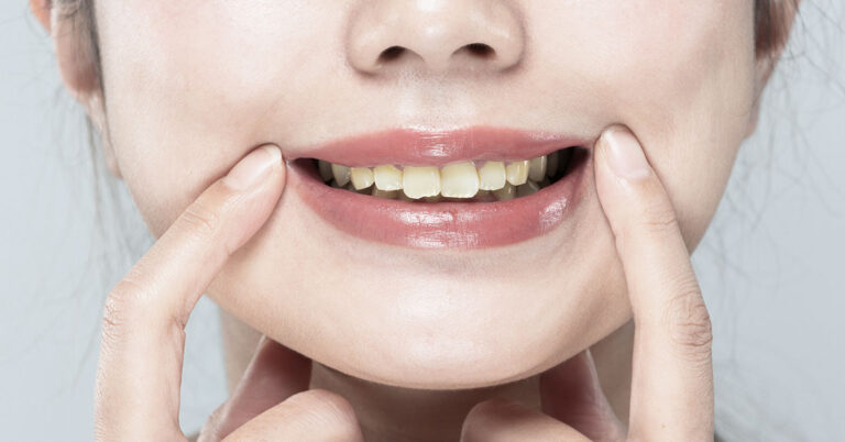 People Often Make This Mistake Which Leads to Yellow Teeth, Dentist Says - Featured image