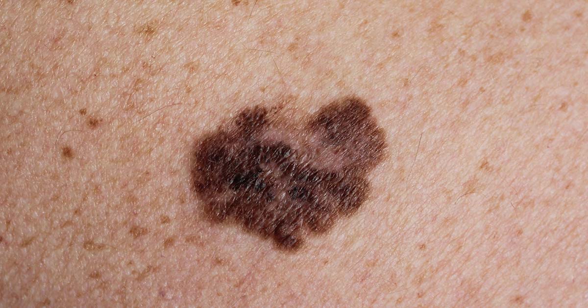 Video Time-Lapse Shows How Dark Patch of Skin Turns Into Melanoma Cancer