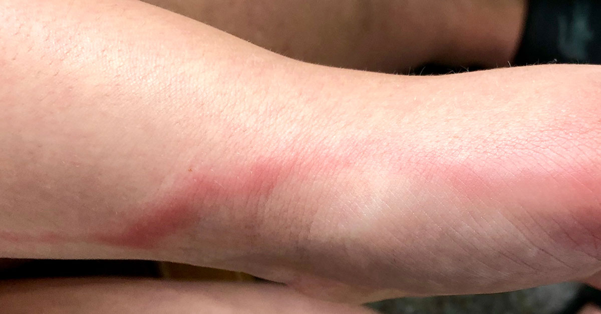 Parents Should Be On The Look Out for Red Tracking Lines That Can Appear On Their Children – Here’s Why