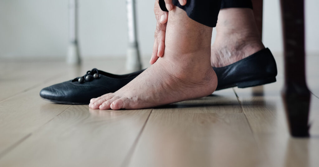 Elderly woman swollen feet putting on shoes