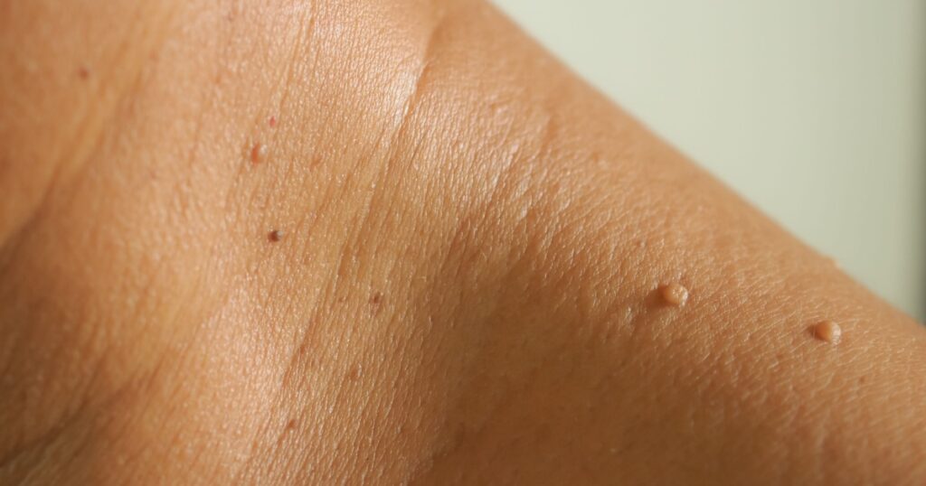 Close-up the skin tags on neck man skin.