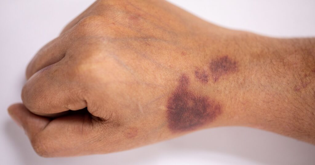 The physical appearance of the arm with the wound is caused by Haemophilia, (Haemophiliais a mostly inherited genetic disorder)