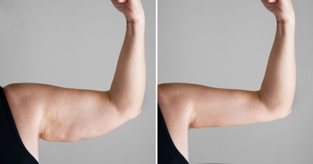 Obesity Cellulite And Fat Removal Surgery Before And After