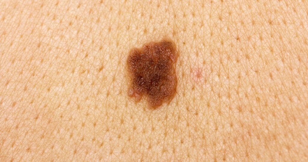 tumor on skin