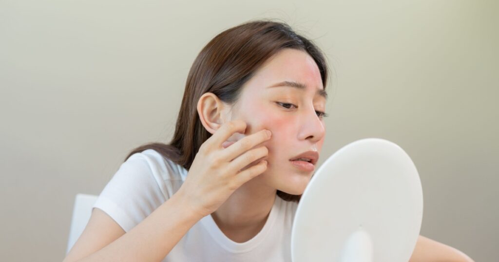 Dermatology, puberty asian