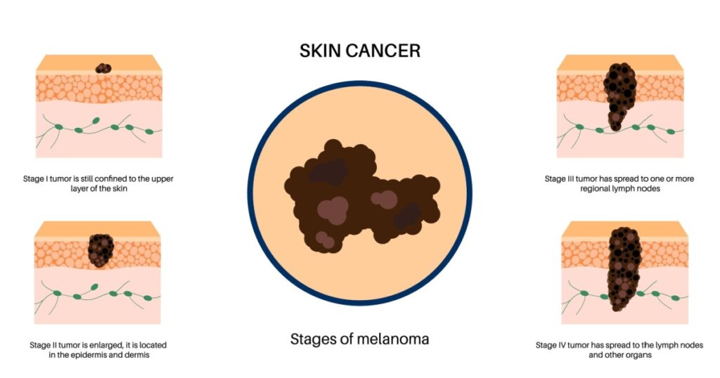 Stages of melanoma skin cancer development and progression. Malignant tumor growth into the skin layers from epidermis to other internal organs. Diagnostic and treatment in dermatology clinic vector