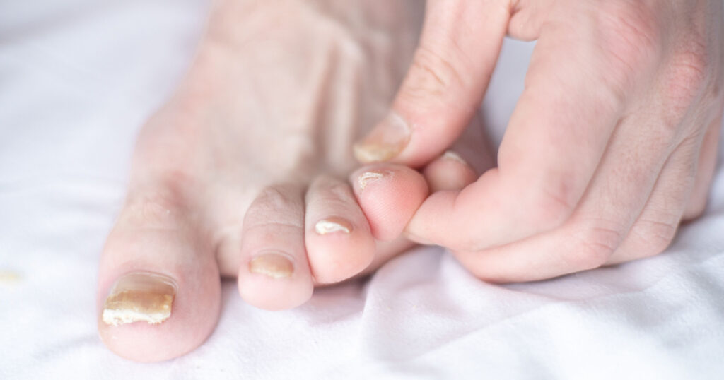Male cut nails with nail fungus. Fungal infection on nails legs, finger with onychomycosis. Care and treatment. Closeup of a foot with damaged nails because of fungus