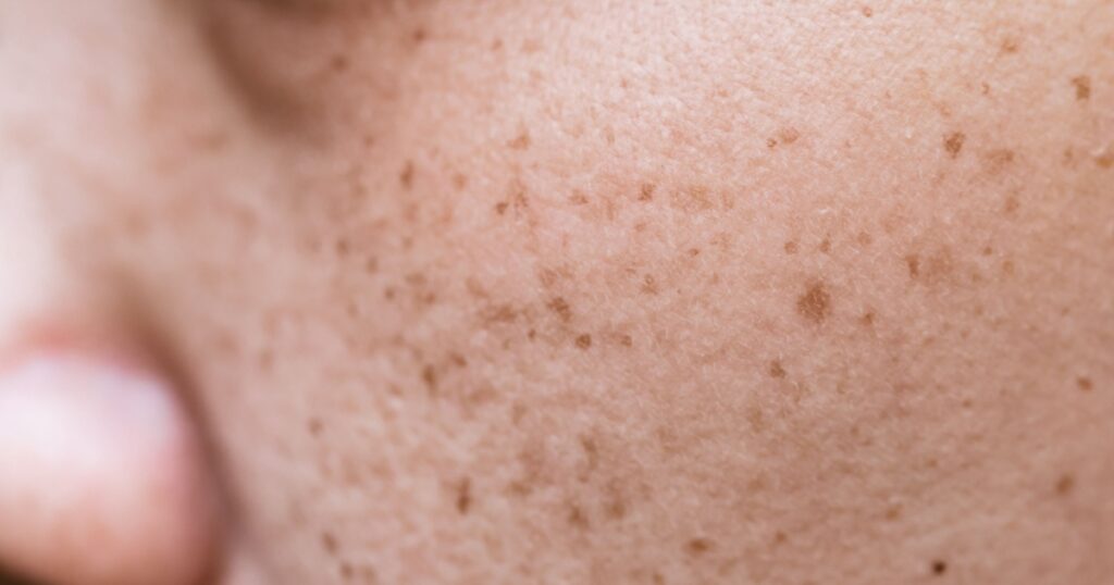 Freckles Over Asian Woman Face,Skin Problems