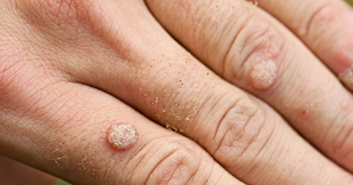Home Remedies To Help Get Rid Of Those Stubborn Warts