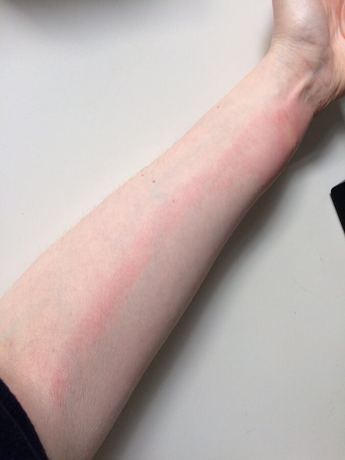 rash on arm