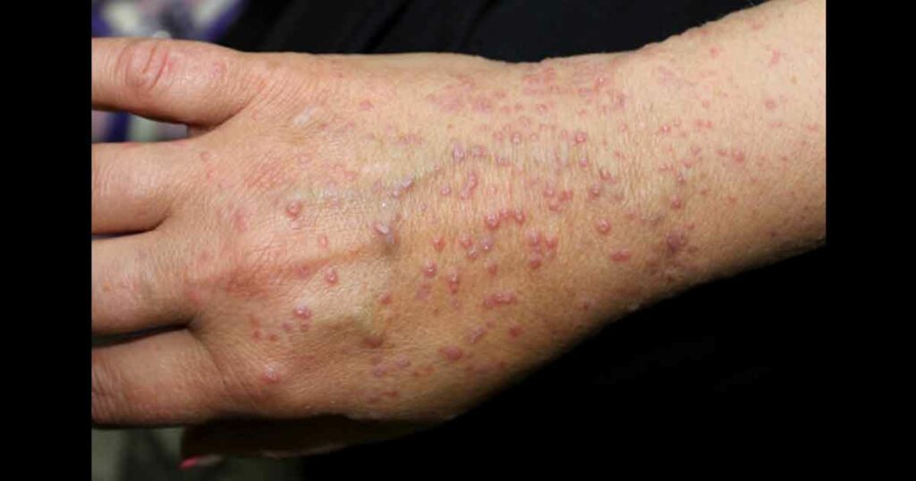 A case of lichen planus in a woman.