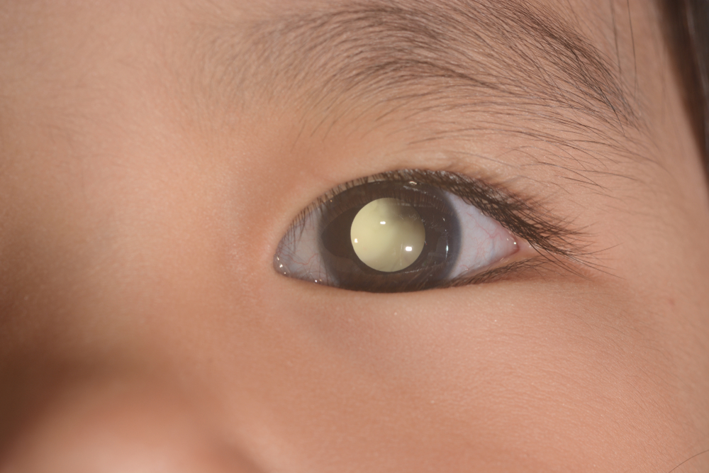 close up of the leukocoria during eye examination.