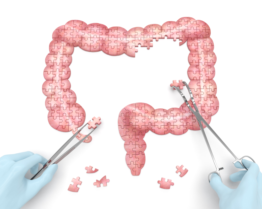 Large intestine puzzle concept: hands of surgeon with surgical tools perform colon surgery as a result of diverticulitis, Colitis ulcerosa, appendicitis, Crohn's disease, colonic polyp. 3d rendering