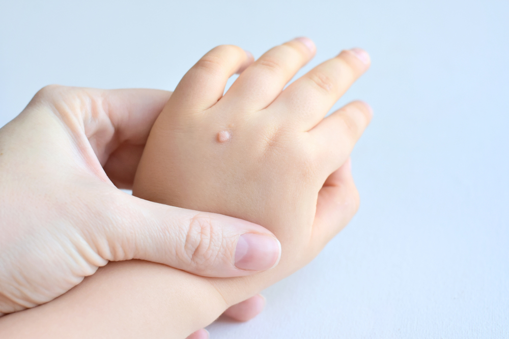 The doctor holds a small hand of a child affected with warts on little fingers and back of the hand. Papillomavirus in a child's hand and fingers. Pediatric dermatology. Skin diseases