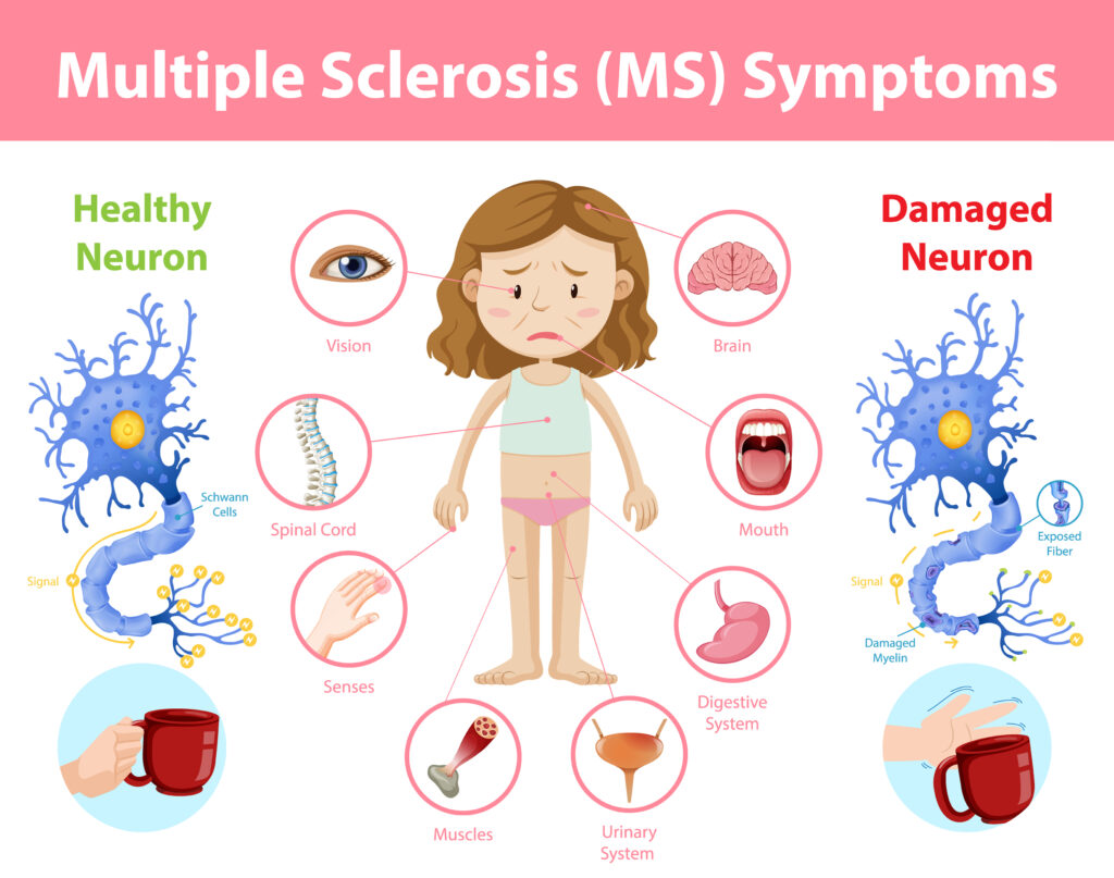 Multiple sclerosis (MS) symptoms information infographic illustration