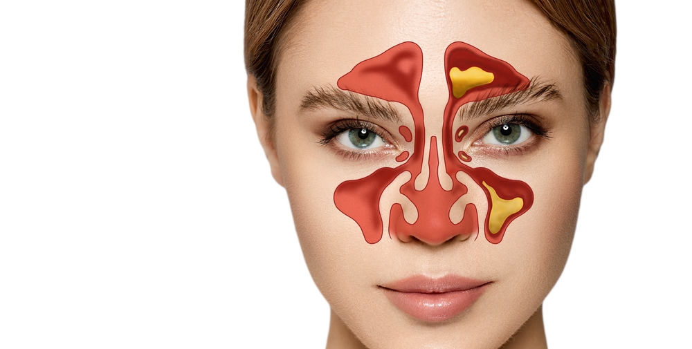 Sinusitis, frontitis. Female face with inflammation of mucous membrane of paranasal and frontal sinuses
