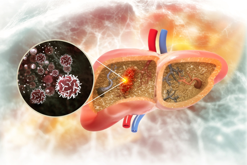 Liver cancer or liver tumor, Hepatocellular carcinoma (HCC), causes, symptoms, treatments, 3d illustration