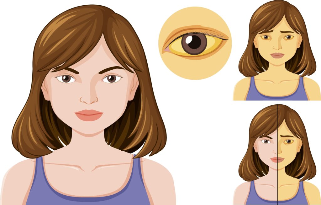 Jaundice disease vector concept illustration
