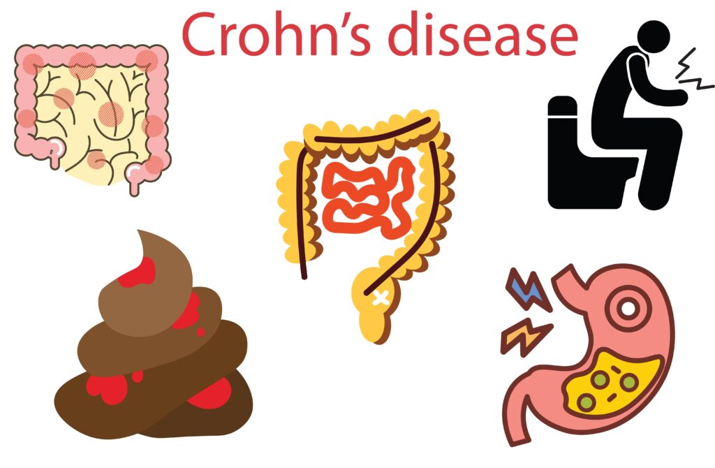 crohn’s disease,Crohn's disease black icon,Stomach Disease,bloo poop,.Autoimmune diseases.blood poop, stomachache campylobacter infection. Bacteria in intestine in flat design.
