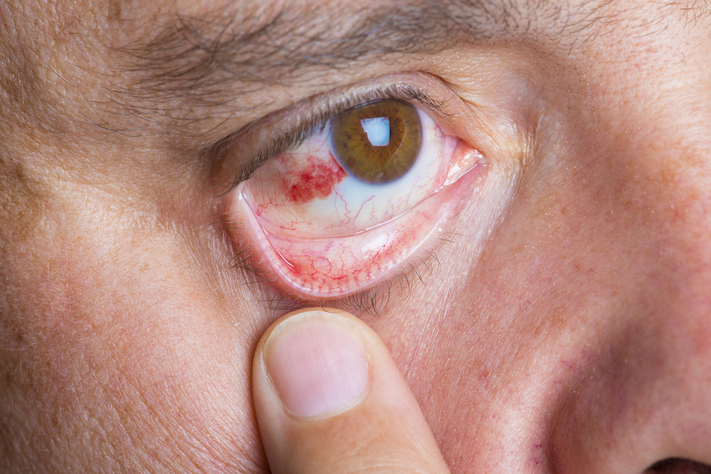 Red bloodshot eyes in a middle aged man
