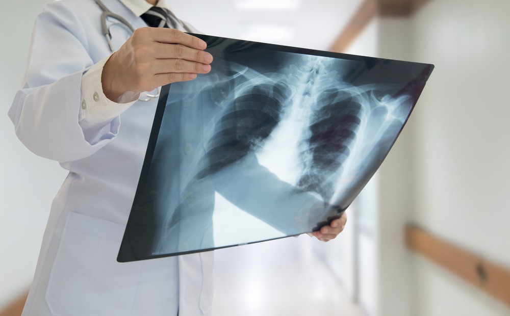 doctor checking chest x-ray film at ward hospital.