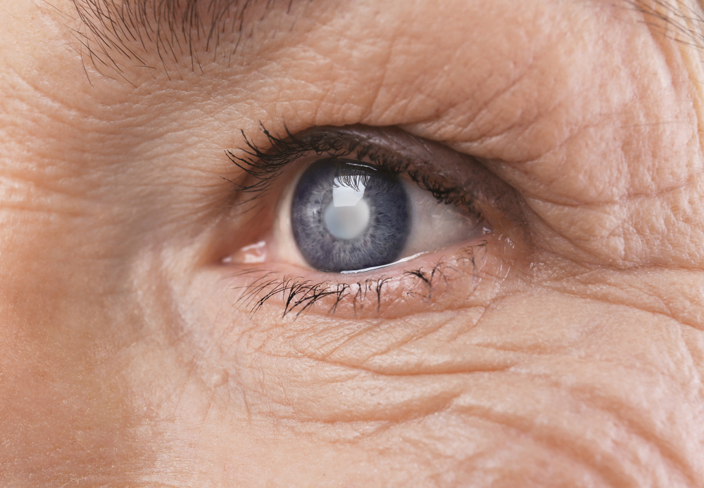 Cataract concept. Senior woman's eye, closeup
