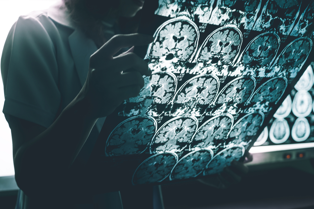 alzheimer's disease on MRI