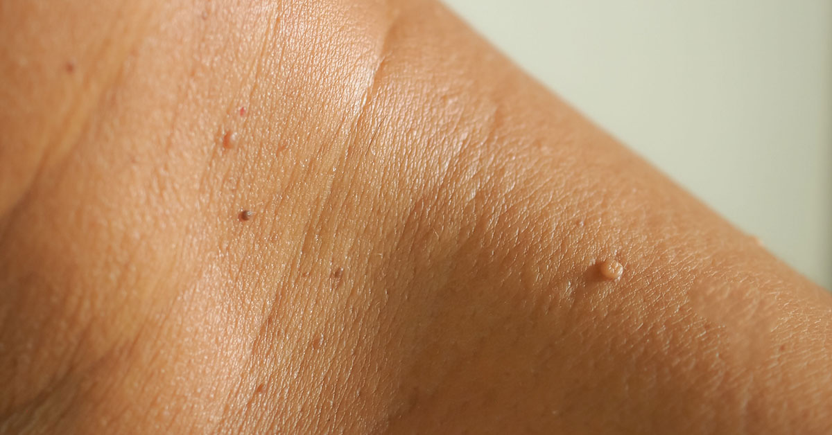What Are Skin Tags? (Signs, Symptoms, and Remedies)