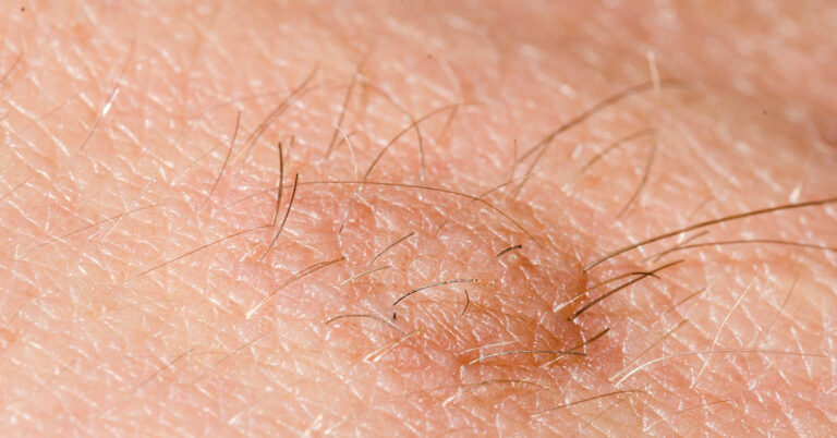 The Cure of Baldness May Have Been Discovered, Scientists Say  — and It’s Hiding In Your Hairy Moles - Featured image