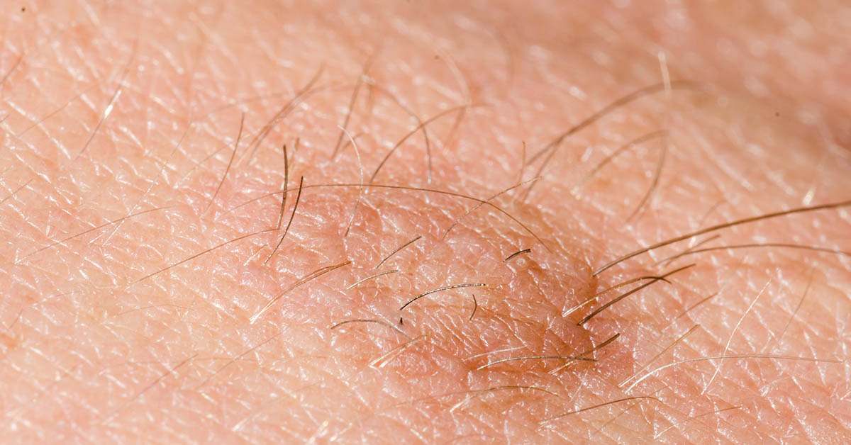 The Cure of Baldness May Have Been Discovered, Scientists Say  — and It’s Hiding In Your Hairy Moles