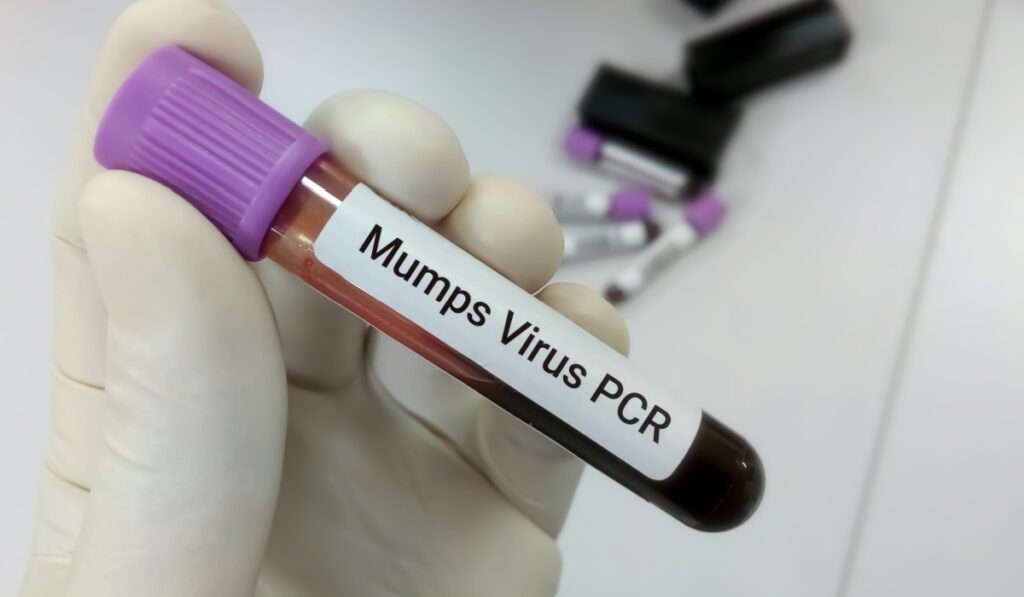 Molecular Biologist hold blood sample for Mumps Virus PCR test. blur background