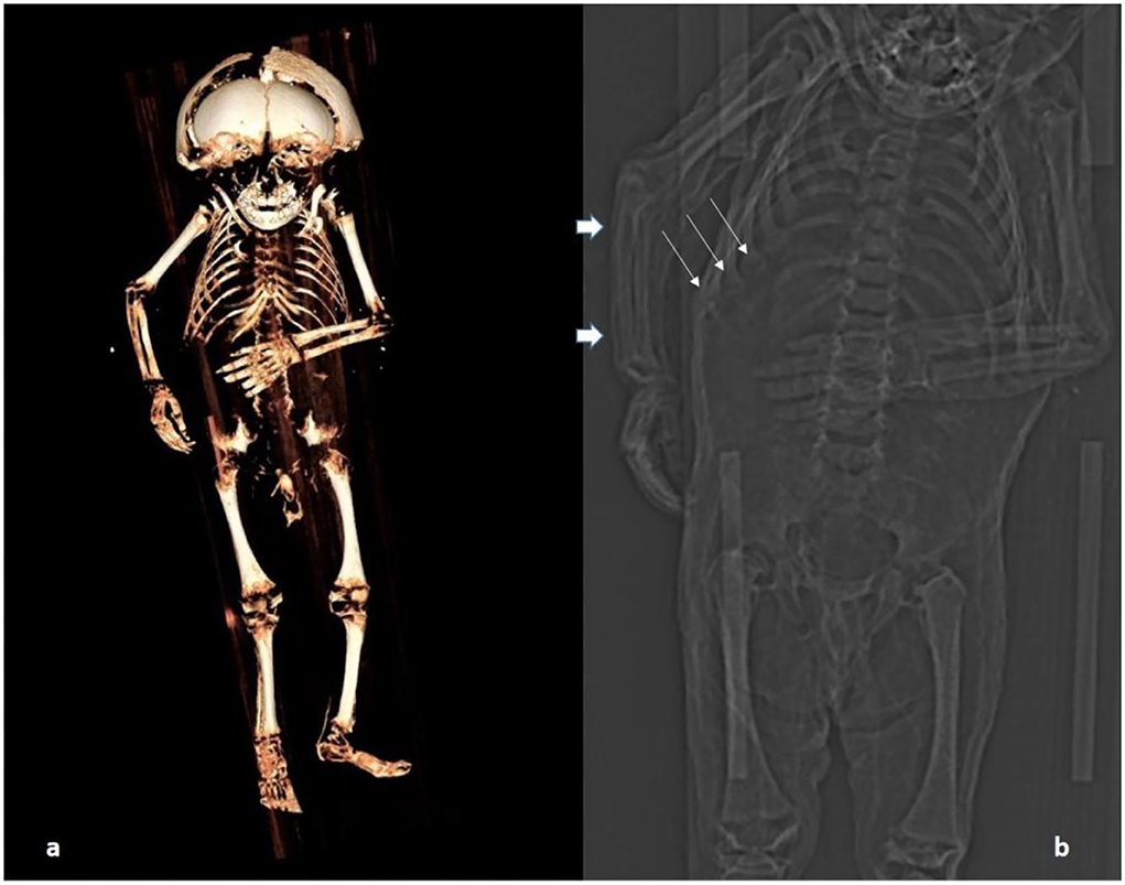 virtual autopsy