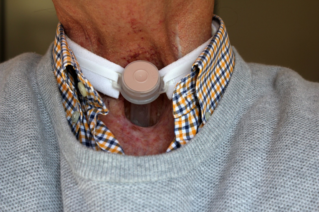 Laryngectomy from cancer