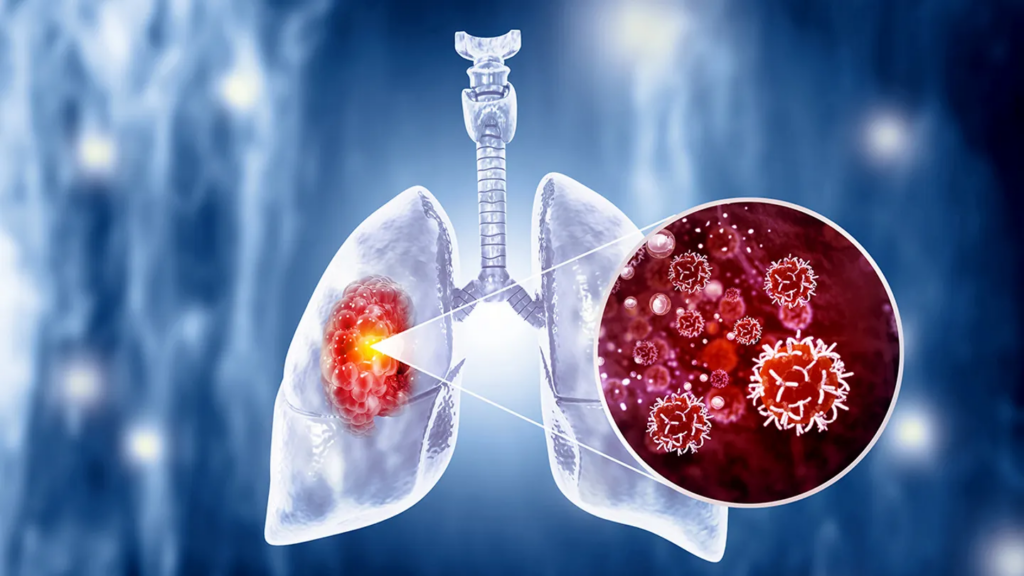 lung cancer closeup