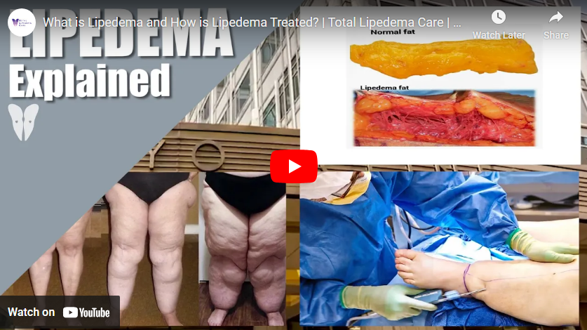 Lipedema youtube video