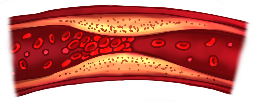 Blood Clot
