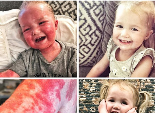 Instagram eczema picture