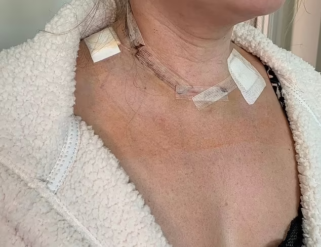 Abi post-surgery