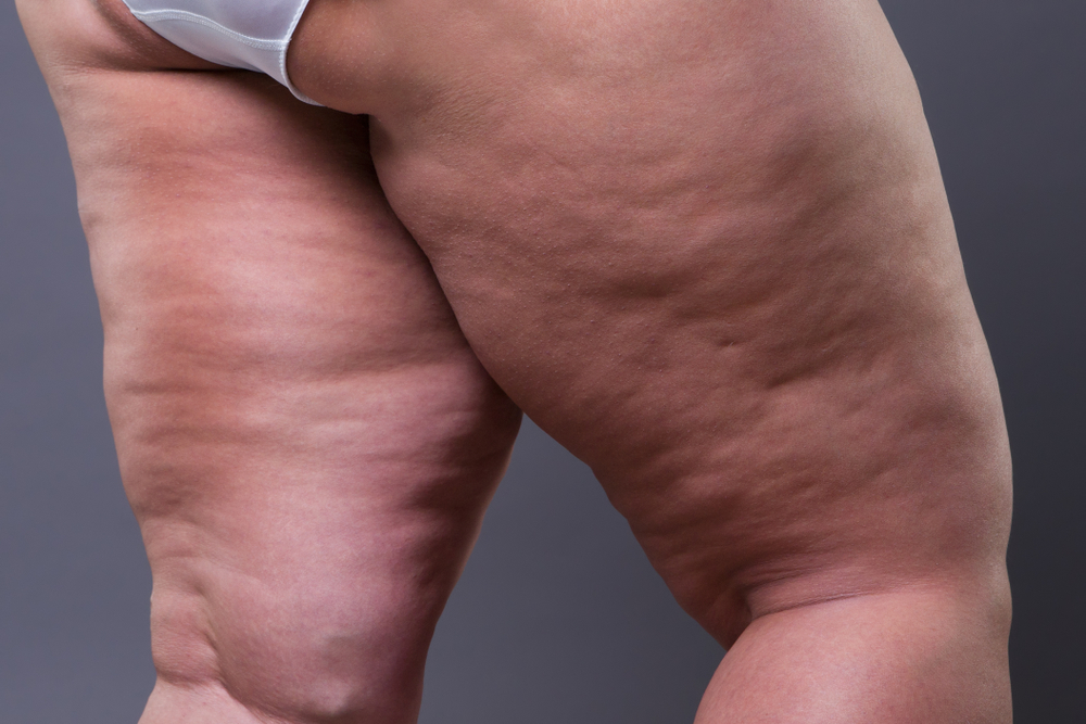 Fat female body with cellulite, overweight hips and legs on gray background