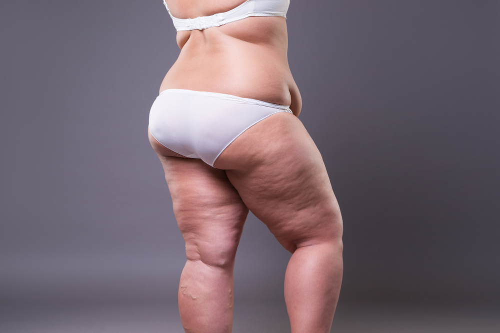 Overweight woman with fat legs and buttocks, obesity female body on gray background