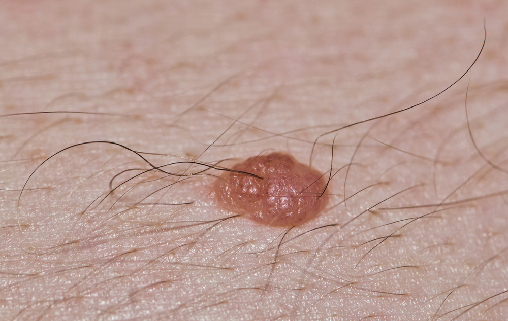 Mole with hair on fair caucasian skin. Dermal mole Melanocytic nevus macro image with copy space and selective focus.