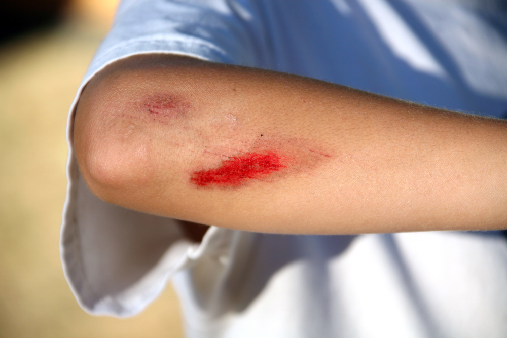 Young Child With Bloody Scrape on Arm