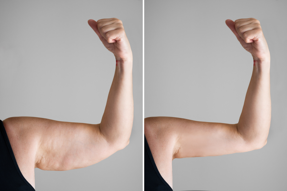 Obesity Cellulite And Fat Removal Surgery Before And After